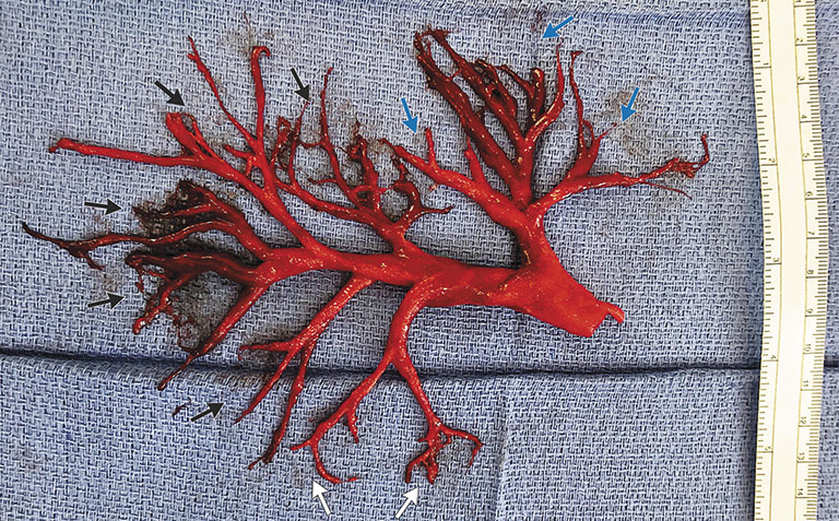 Cast of the right bronchial tree