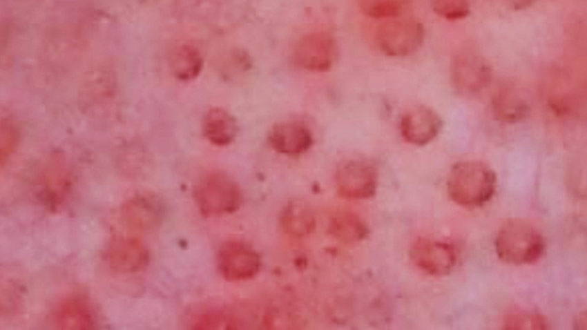 Doughnut lesions