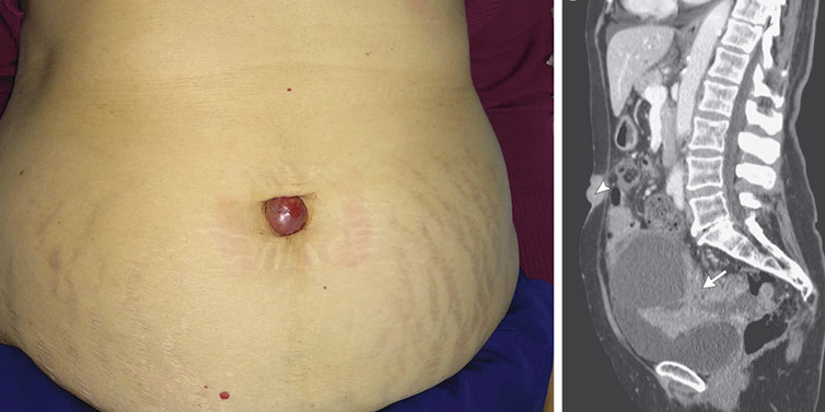 Umbilical nodule
