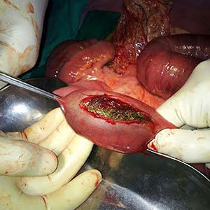 hairball intestine
