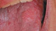 lichen planus