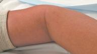 lymphangioma