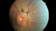 direct ophthalmoscopy