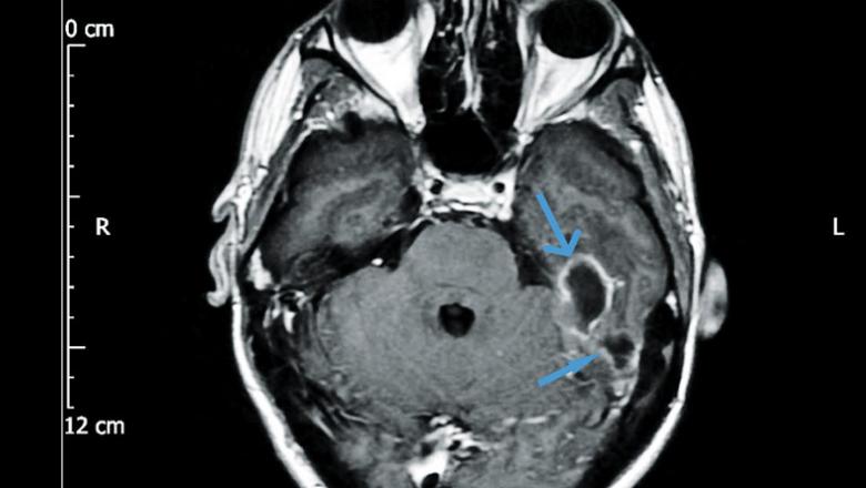 MRI