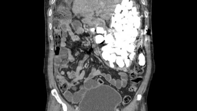 gastric foreign bodies