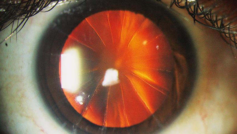Eye with incisions