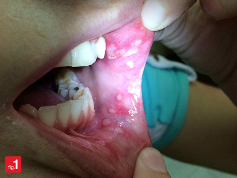 mouth ulcers