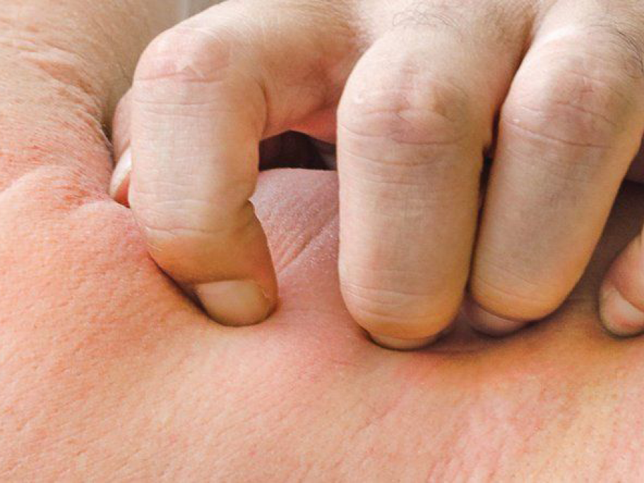 urticaria