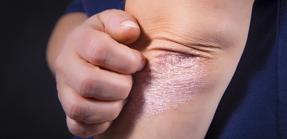 Psoriasis_Elbow