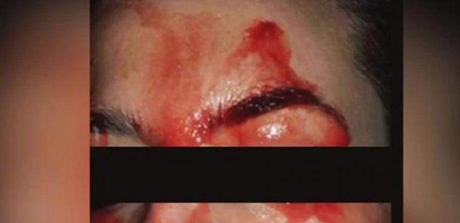 hematohidrosis