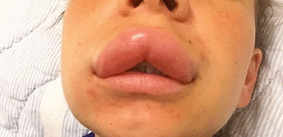 Angioedema