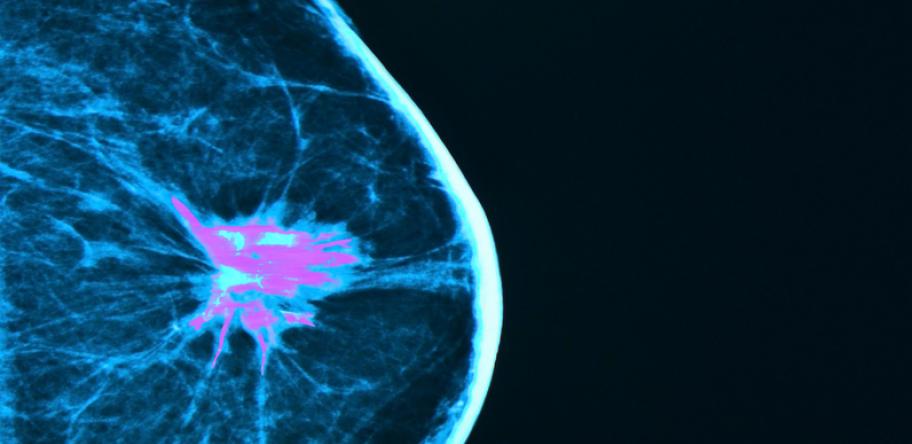 breast cancer