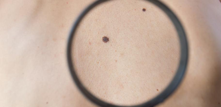 melanoma