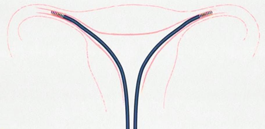 Essure