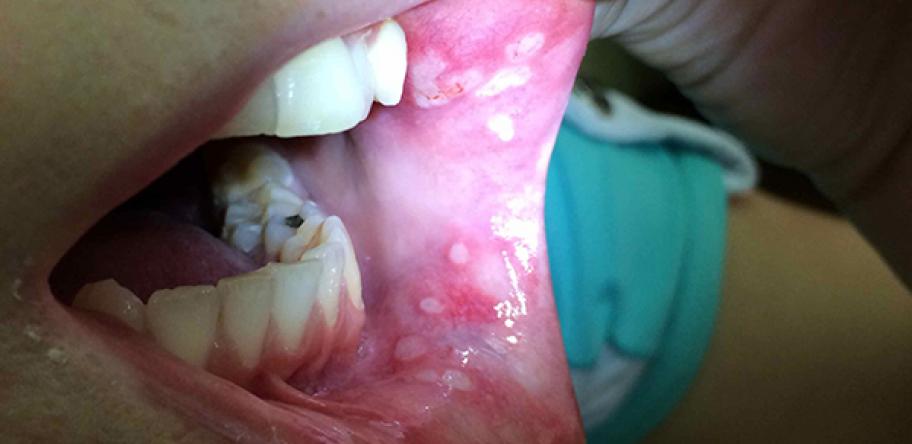 mouth ulcers