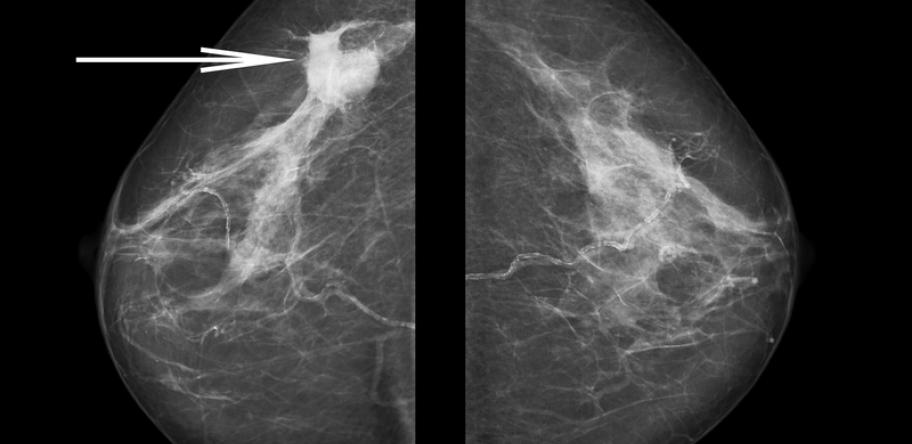 mammogram showing cancer