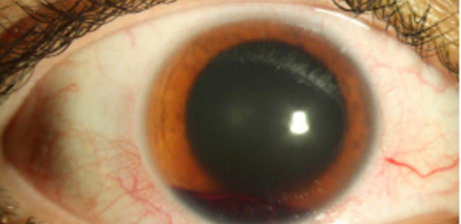 Nerf gun eye injury
