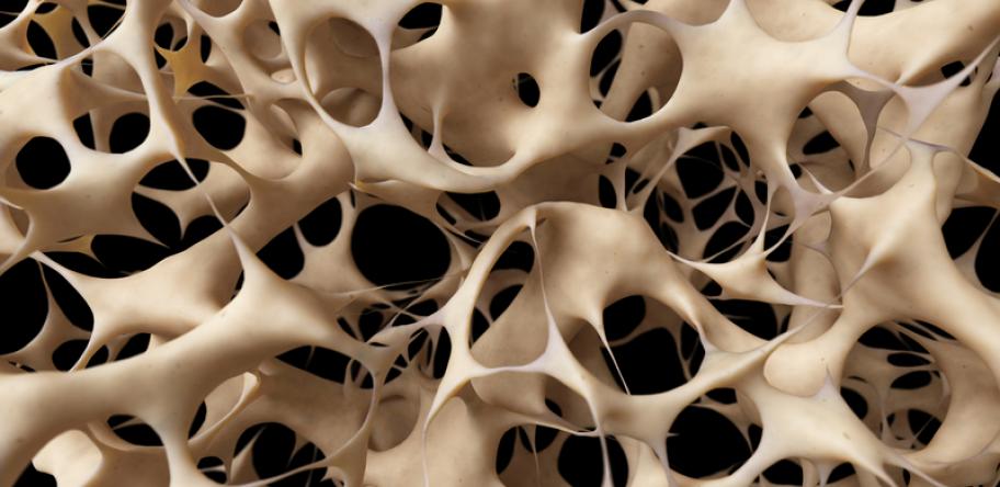 osteoporosis