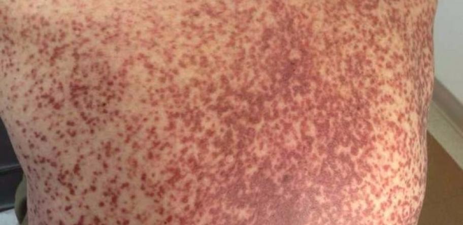 Rash