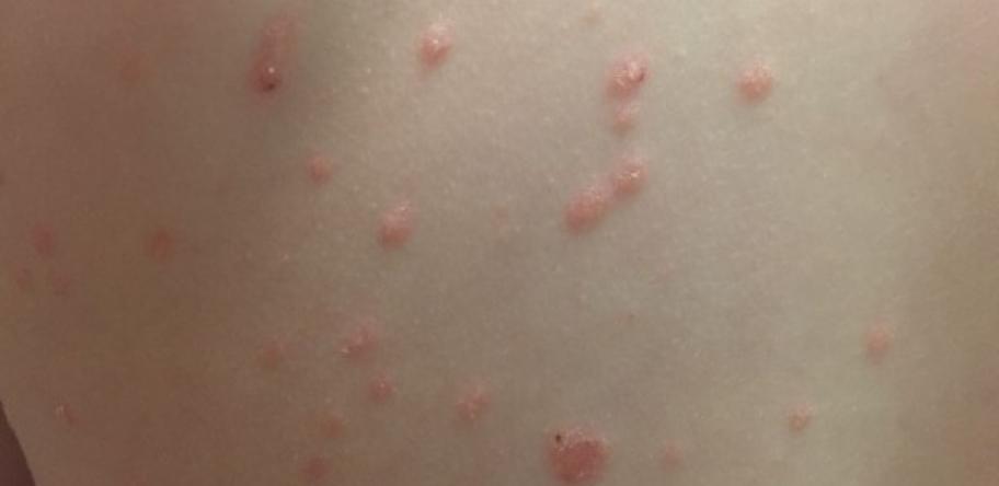 rash