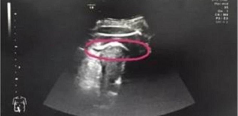 ultrasound of ruptured uterus