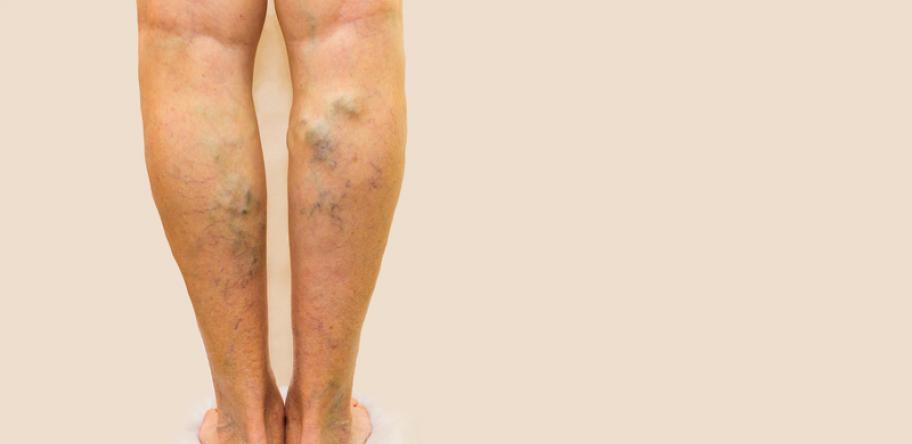 varicose veins
