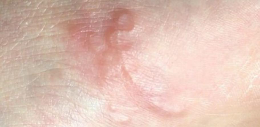 hookworm