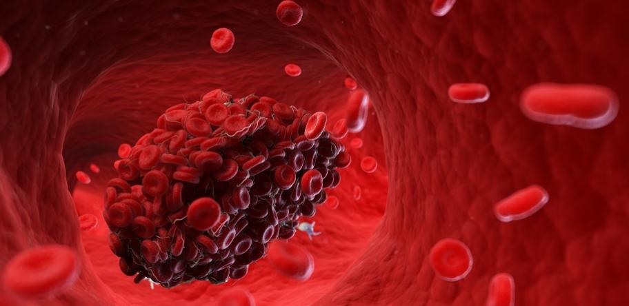 Blood clot