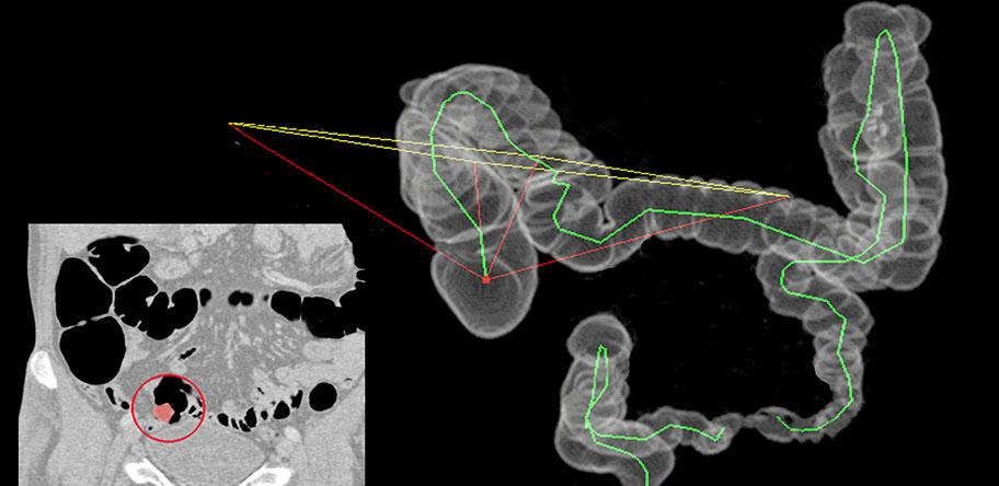 CT colonography