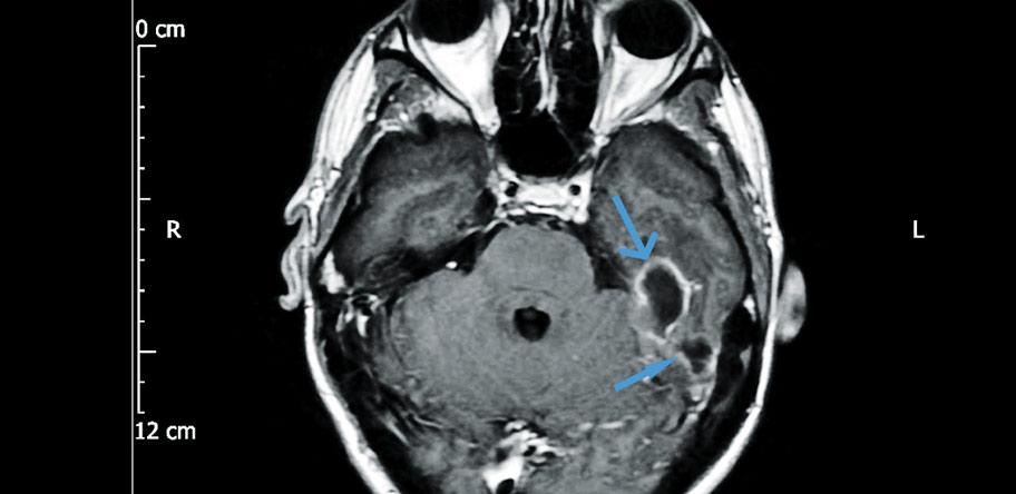MRI