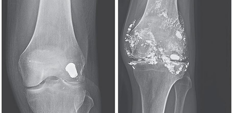 Knee X-ray