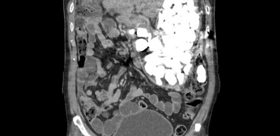 gastric foreign bodies