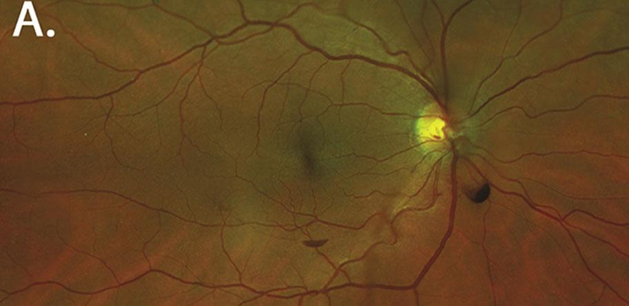 Eye