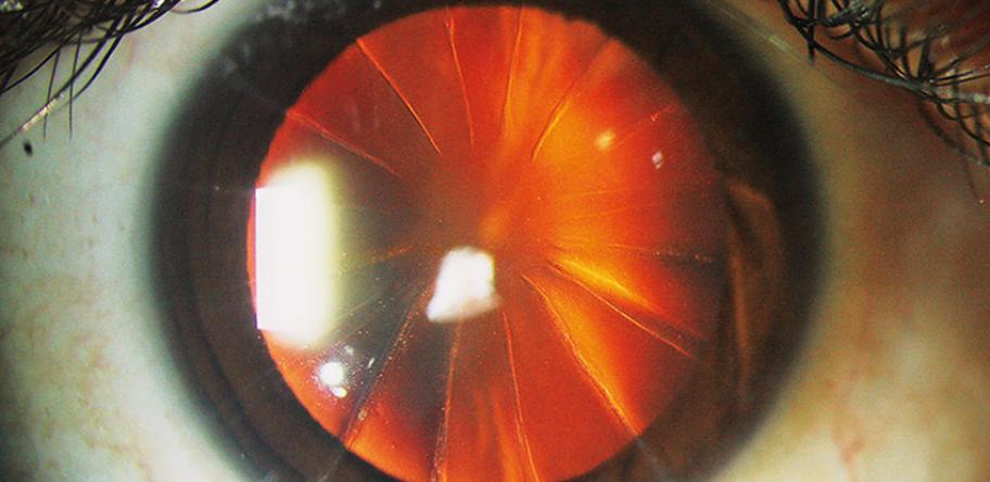 Eye with incisions