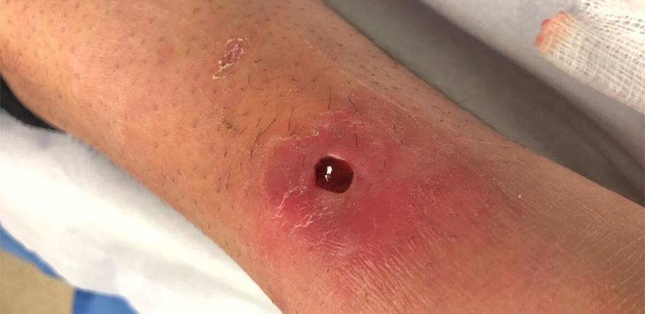 Fig 1_ulcer at presentation
