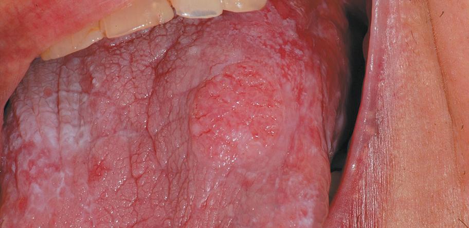 lichen planus