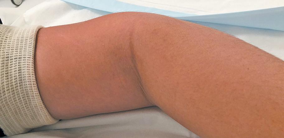 lymphangioma