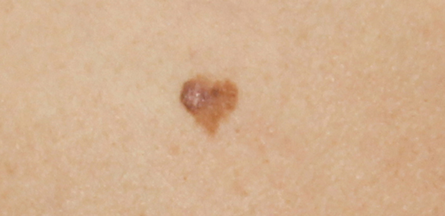 heart-shaped lesion
