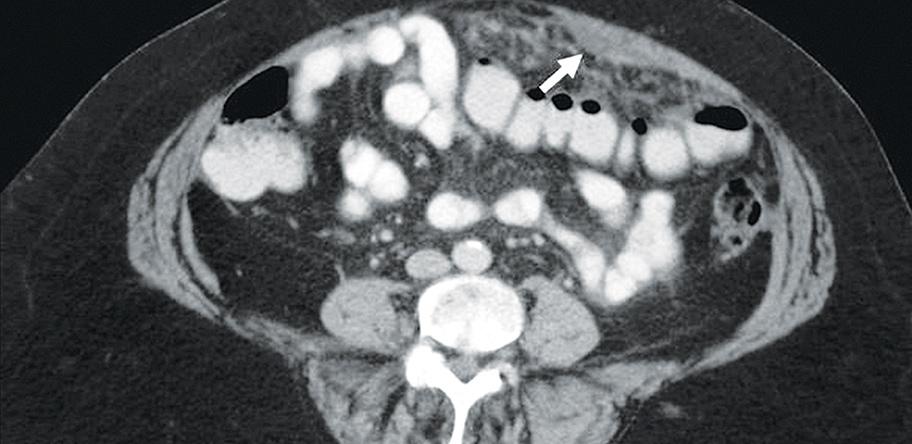 Figure 1. CT abdomen demonstrating loculated ascitic fluid (arrow) anterior to the omentum.
