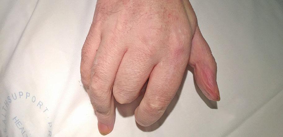 CRPS