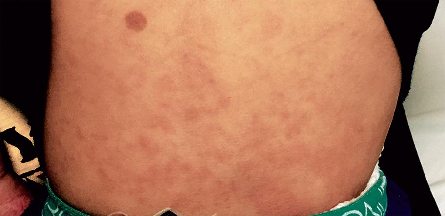 maculopapular-rash