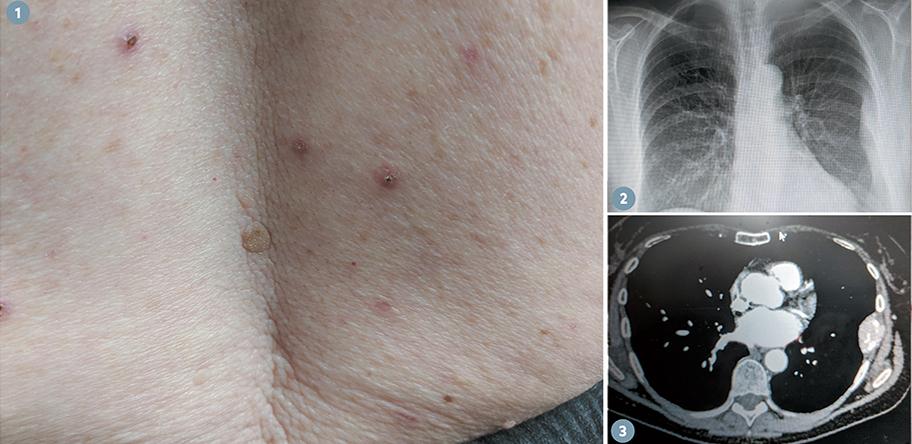 Papules and vesicles on the back