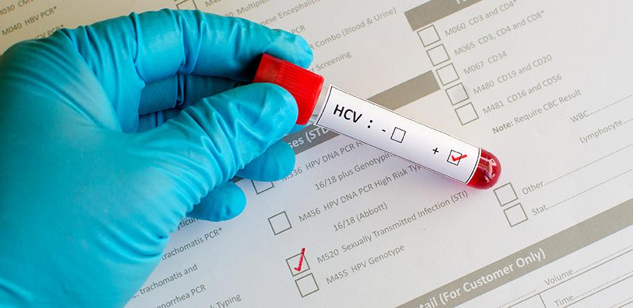 HCV test