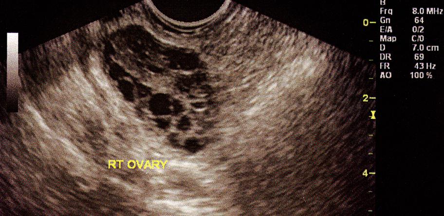 PCOS