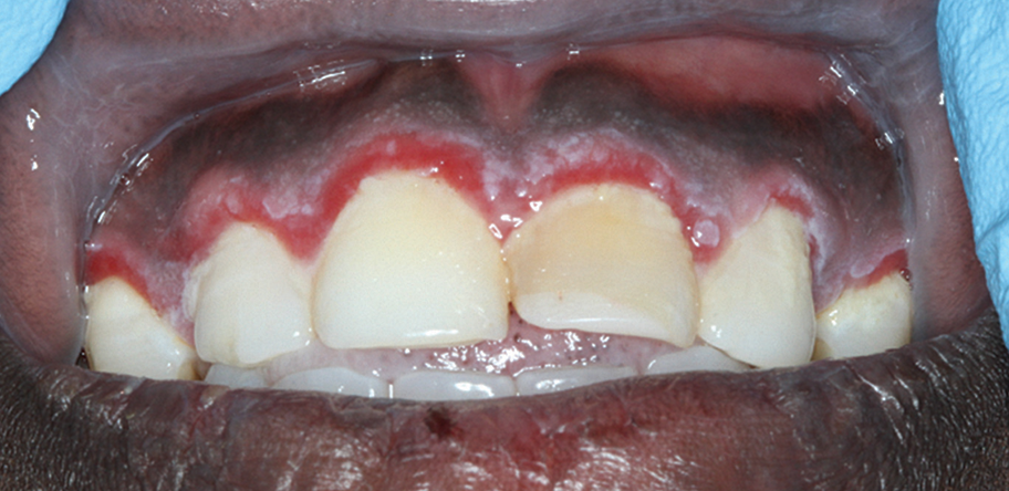 bleeding gums