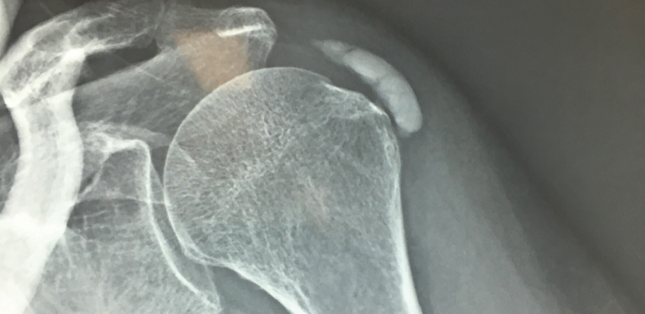 calcific tendinitis