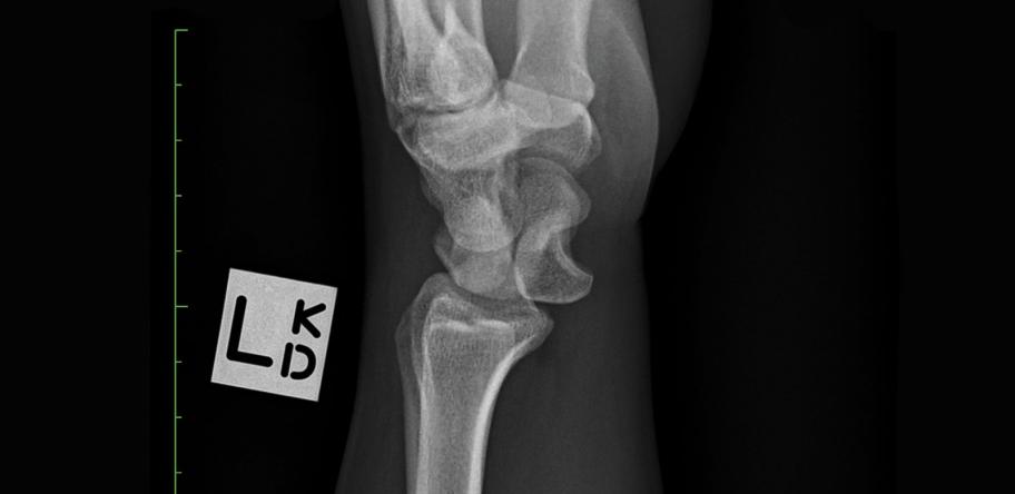 carpal tunnel