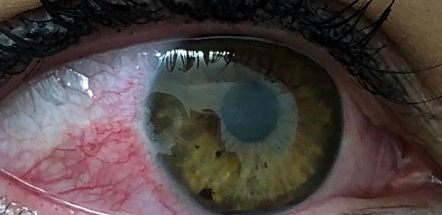 ulceration