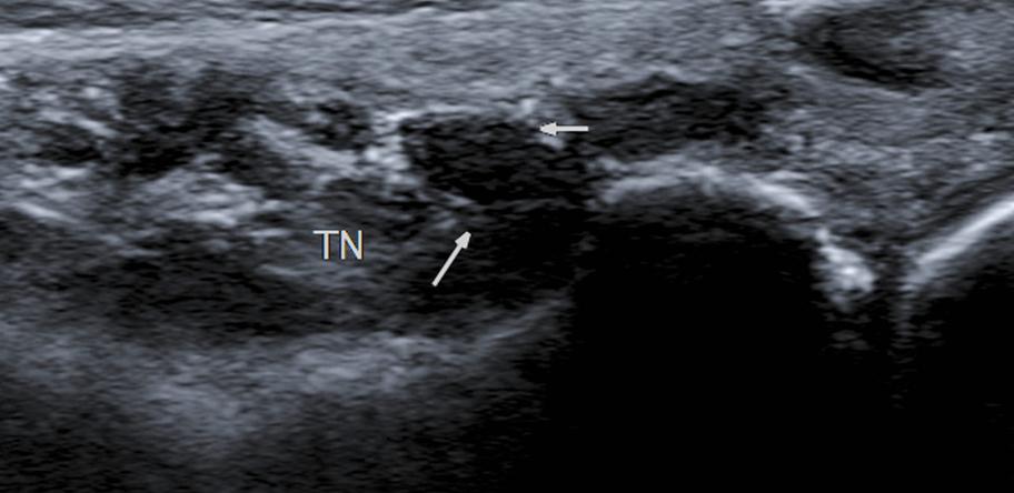 Ganglion cyst