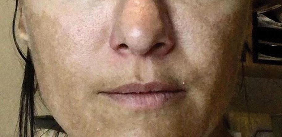 melasma